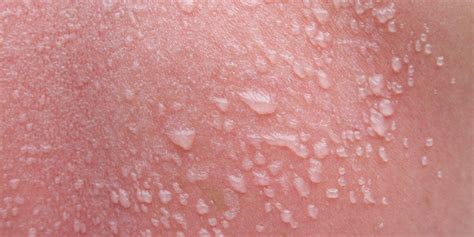 why is my sunburn leaking yellow|Sun Blisters: How to Treat Them and How Long They Last